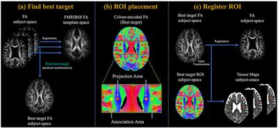 Assessing interstitial fluid dynamics in type 2 diabetes mellitus and prediabetes cases through diffusion tensor imaging analysis along the perivascular space